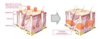 프락셀 레이저 피부 단면 원리 도해 이미지 (ICRE XCL Scanning Fractional Laser - epidermis, Dermis, subcermis &rarr; Collagen remodulation)